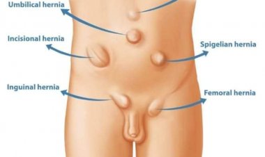 Labarin Ciwon  Labarin Ciwon  HERNIA Da Yanda Za'a Magance Shi
