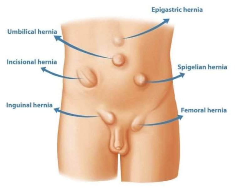Labarin Ciwon  Labarin Ciwon  HERNIA Da Yanda Za'a Magance Shi