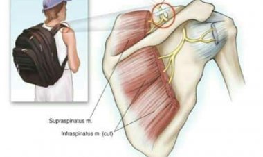 Shawarwari Bakwai Ga Masu Rataya Jakar Baya Domin Kiyaye Ciwukan Jiki