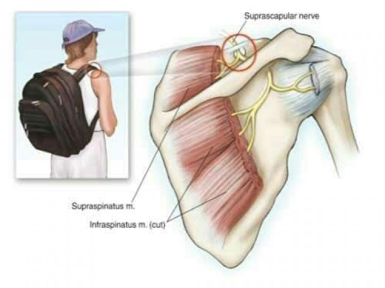 Shawarwari Bakwai Ga Masu Rataya Jakar Baya Domin Kiyaye Ciwukan Jiki