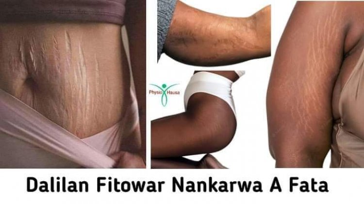 Daman ba iya mai juna biyu Tsagewar fatar ciki ke fitowa ba?