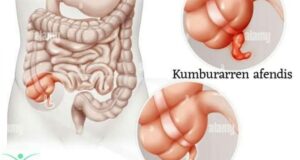 Ciwon Afendis: Abubuwa 10 da ya kamata ka sani game da shi